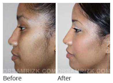 rhinoplasty before and after flat nose