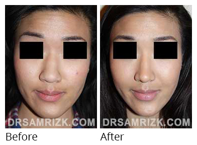 Female face, before and after Rhinoplasty treatment, front view, patient 35