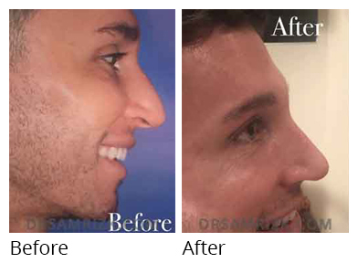 rhinoplasty before and after male