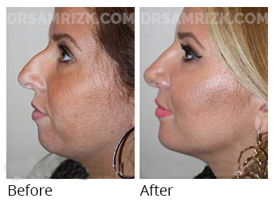 Woman's face, before and after Chin and cheek treatment, side view, patient 4