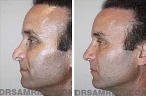 Man's face, before and after Revision Rhinoplasty treatment, l-side view