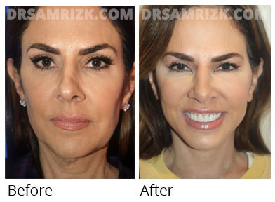 Facelift Before After Gallery New York Face Lift Photos Nyc