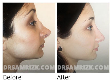 Female face, before and after Rhinoplasty treatment, side view, patient 58