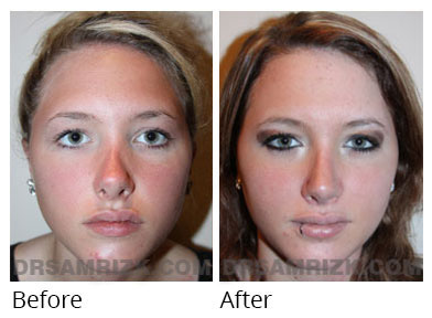 Female face, before and after Rhinoplasty treatment, front view, patient 60