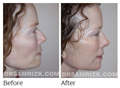 Female face, before and after Rhinoplasty treatment, front view, patient 67