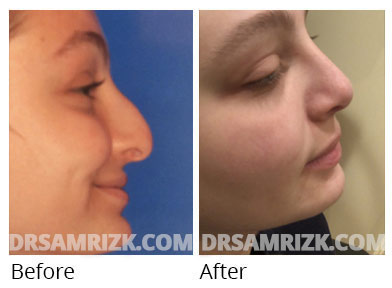 Female face, before and after Rhinoplasty treatment, front view, patient 69