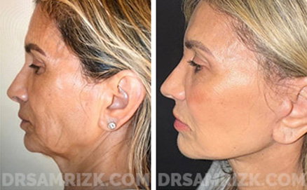 66 yo patient looking amazing 6 months after deep plane facelift / deep necklift / platysmaplasty / temporal browlift and fat transfer to cheek area / lower eyelids . Patient has great jawline and youthful cheeks looks 20 years younger.