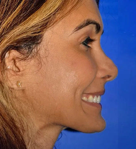 man photo Nose With Cartilage Grafts