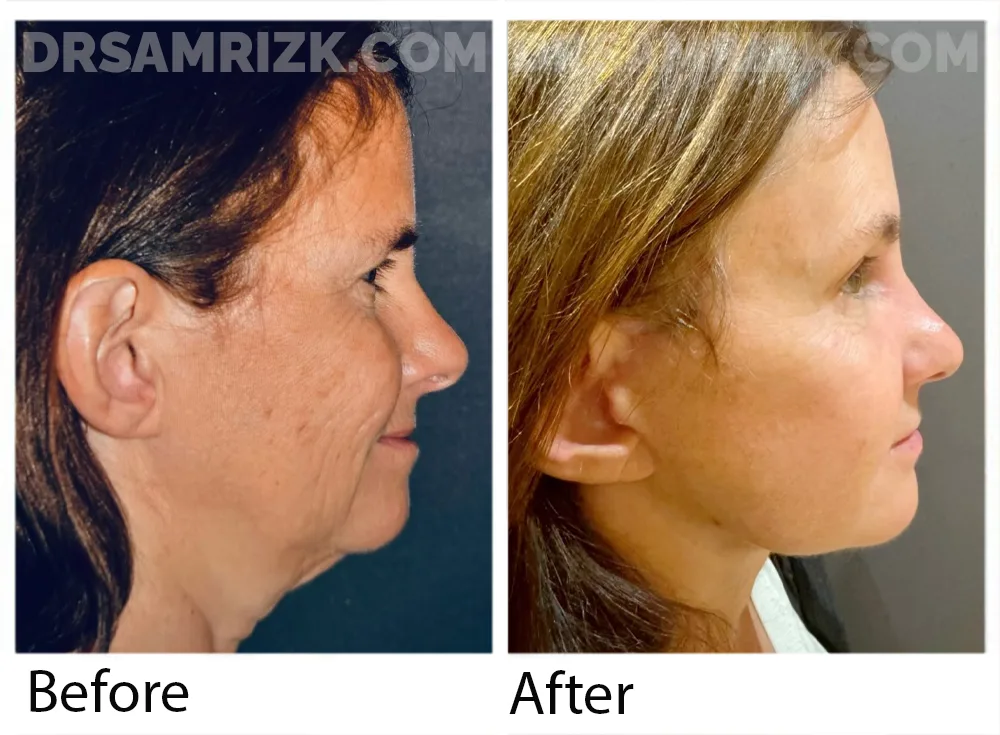 56 yo patient shown 6 months post deep plane facelift / deep necklift / browlift / blepharoplasty & laser . Note jawline definition and more youthful brow position