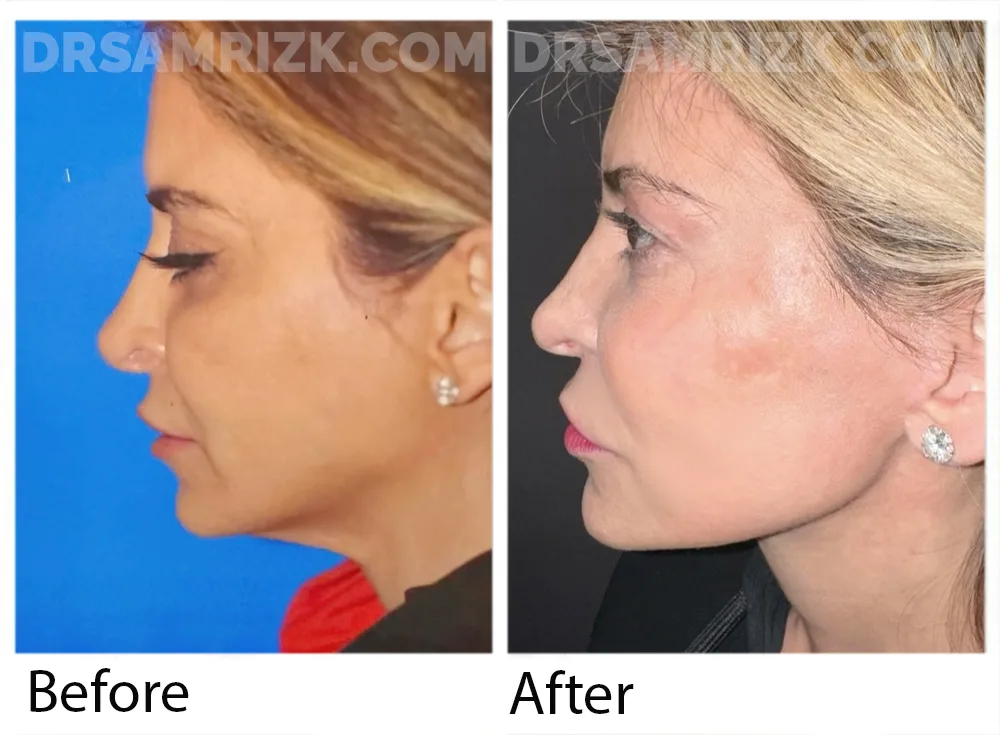 44 yo patient shown 1 year after deep plane facelift/deep necklift / platysmaplasty and fat transfer to cheeks. Note dramatic jawline definition and elongated elegant appearance of jawline.