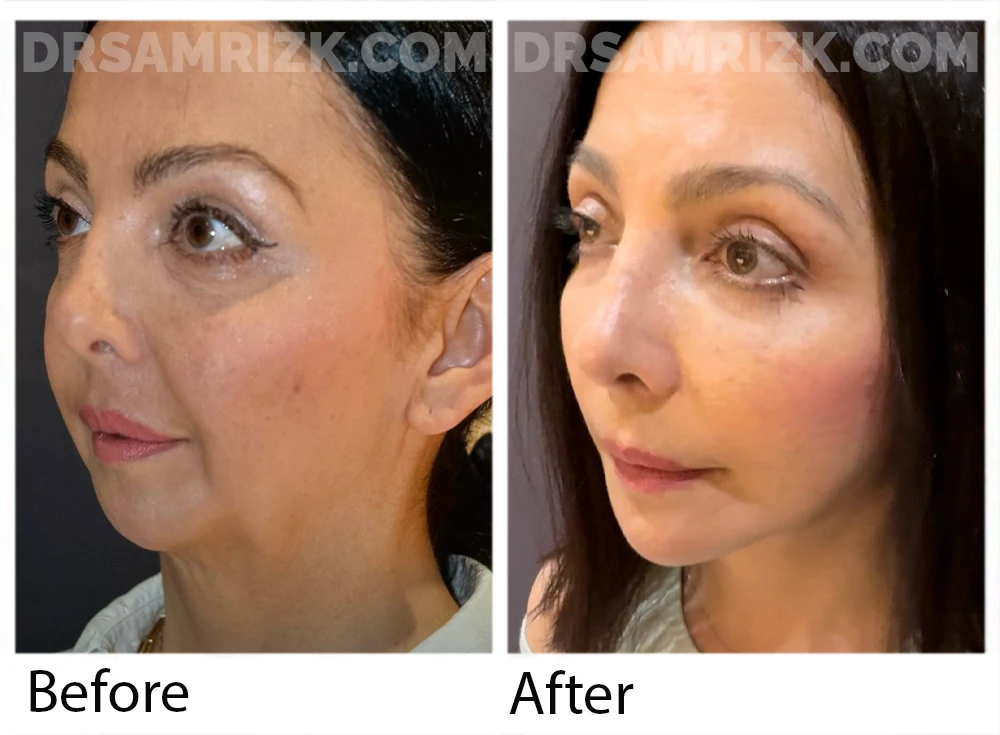 55 yo patient shown 6 months post deep plane facelift / deep necklift / fat transfer to jawline and lower eyes and upper blepharoplasty. Patient always had a weak chin and had already had a chin implant Note jawline definition.