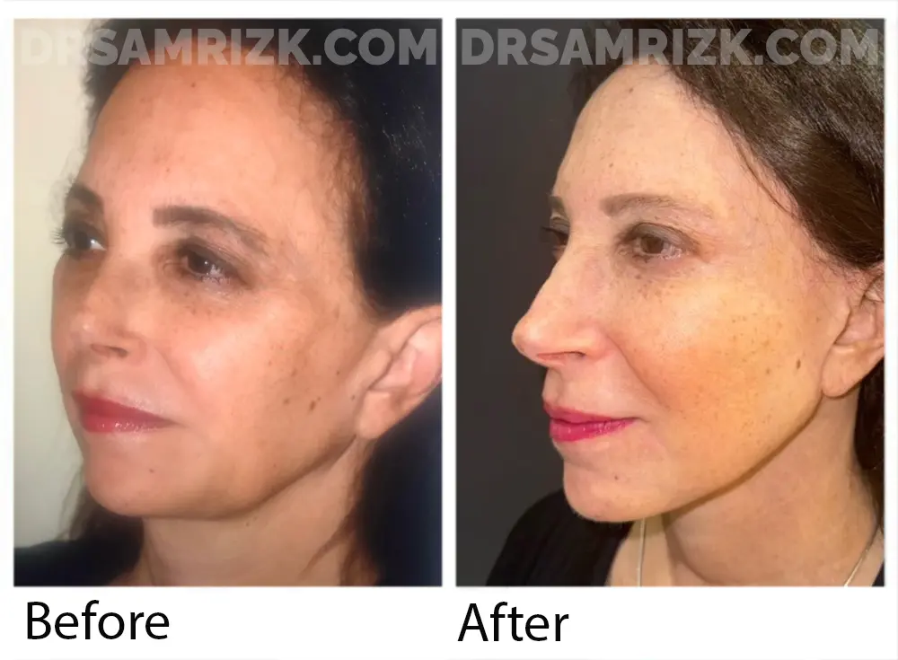 Patient is a New York plastic surgeon who underwent deep plane facelift / deep necklift / temporal browlift / upper blepharoplasty shown 1 year post