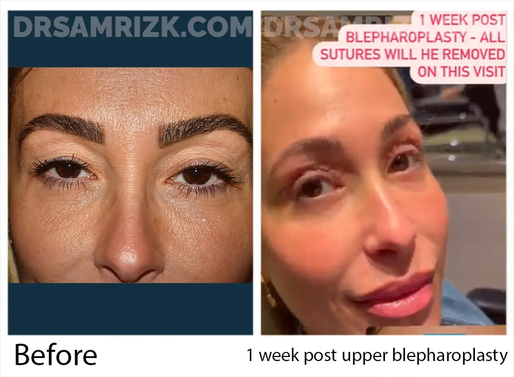 1 week post upper blepharoplasty