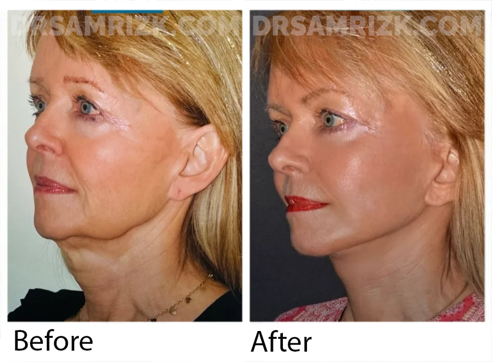 65 yo patient shown 9 months post deep plane facelift / necklift / temporal browlift / blepharoplasty with CANTHOPEXY / fat transfer cheeks and laser . Patient had brought her younger picture in early 40’s and post surgery she looks similar