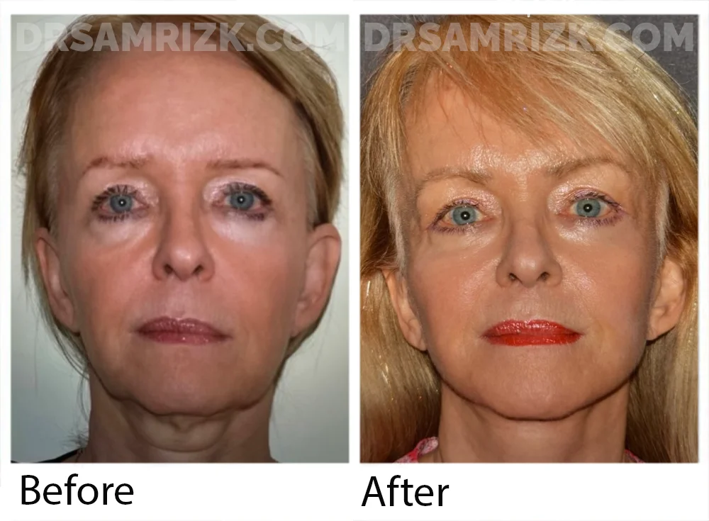 65 yo patient shown 9 months post deep plane facelift / necklift / temporal browlift / blepharoplasty with CANTHOPEXY / fat transfer cheeks and laser . Patient had brought her younger picture in early 40’s and post surgery she looks similar
