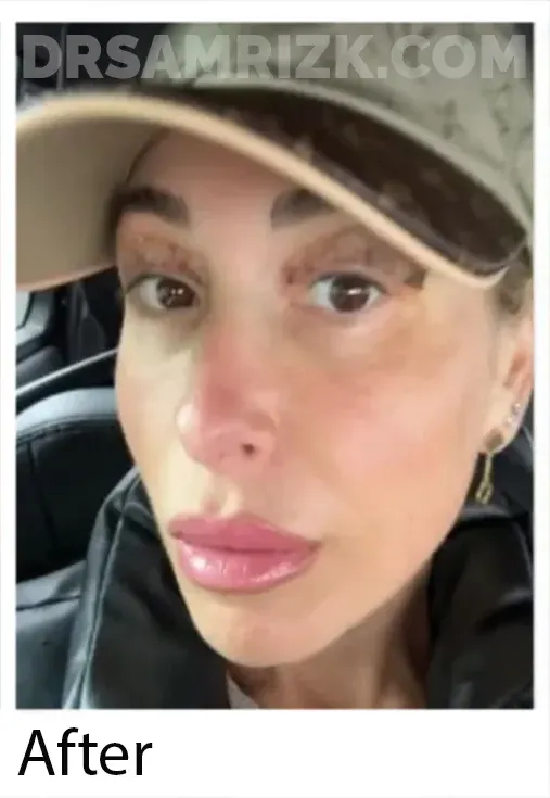 1 week post upper blepharoplasty