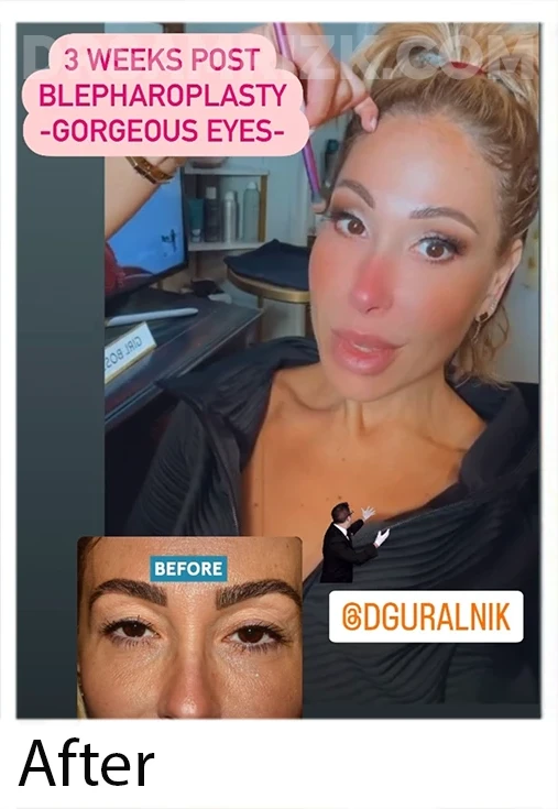 1 week post upper blepharoplasty