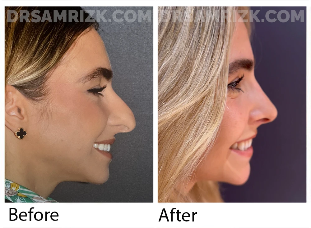 Patient is shown 3 months after rhinoplasty