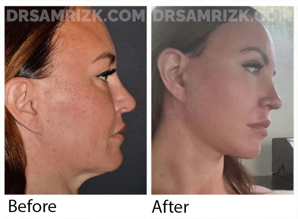 44 yo patient underwent deep plane facelift / necklift / endoscopic browlift / upper and lower blepharoplasty/ revision rhinoplasty with rib / lip lift bullhorn and laser from out of town . She sent her own postoperative pictures 3 months post. She is still mildly swollen but will continue to improve.