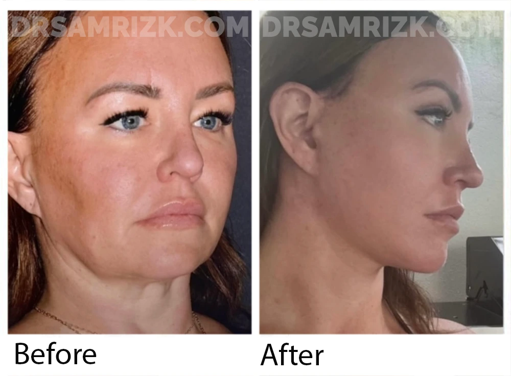 44 yo patient underwent deep plane facelift / necklift / endoscopic browlift / upper and lower blepharoplasty/ revision rhinoplasty with rib / lip lift bullhorn and laser from out of town . She sent her own postoperative pictures 3 months post. She is still mildly swollen but will continue to improve.