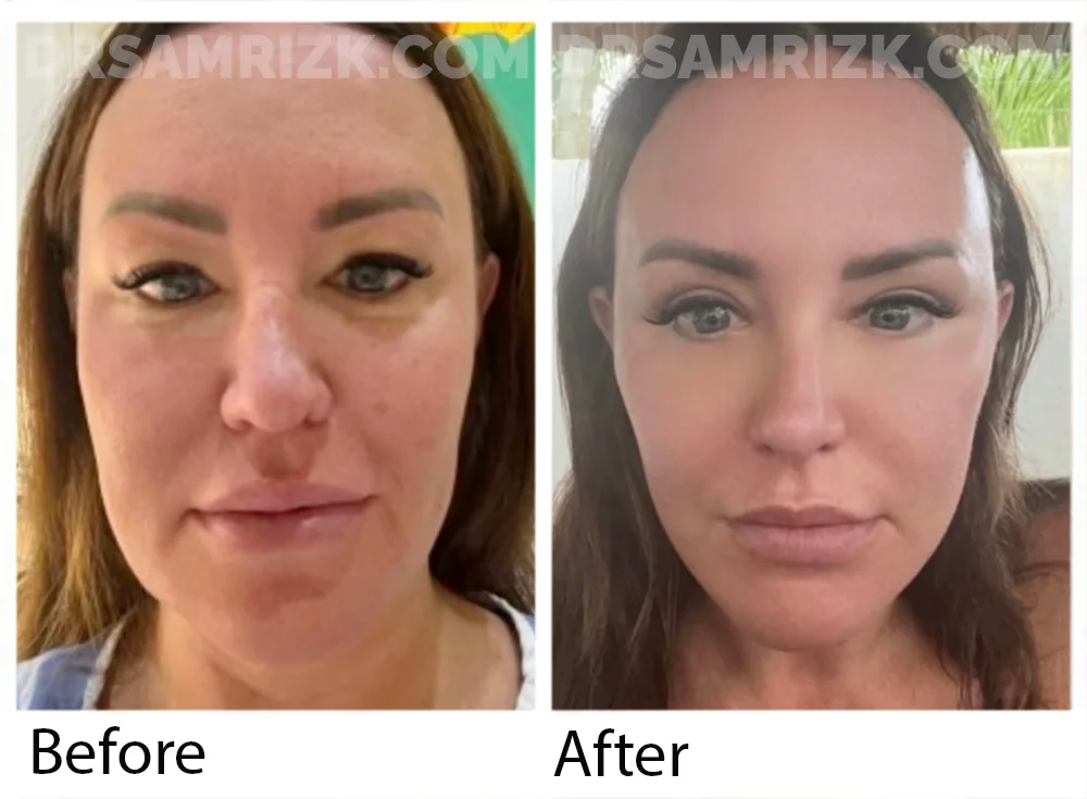 44 yo patient underwent deep plane facelift / necklift / endoscopic browlift / upper and lower blepharoplasty/ revision rhinoplasty with rib / lip lift bullhorn and laser from out of town . She sent her own postoperative pictures 3 months post. She is still mildly swollen but will continue to improve.