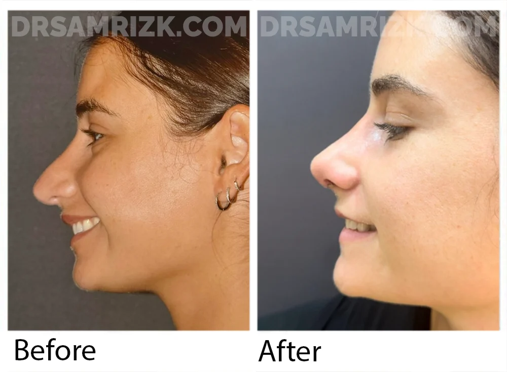 This patient is shown only I week after revision rhinoplasty / septoplasty with MTF rib bank cartilage to correct pollybeak deformity , hanging tip , collapse of right internal and external nasal valve and caudal septal deviation to the right . Her breathing and cosmetic appearance are improved post-surgery.