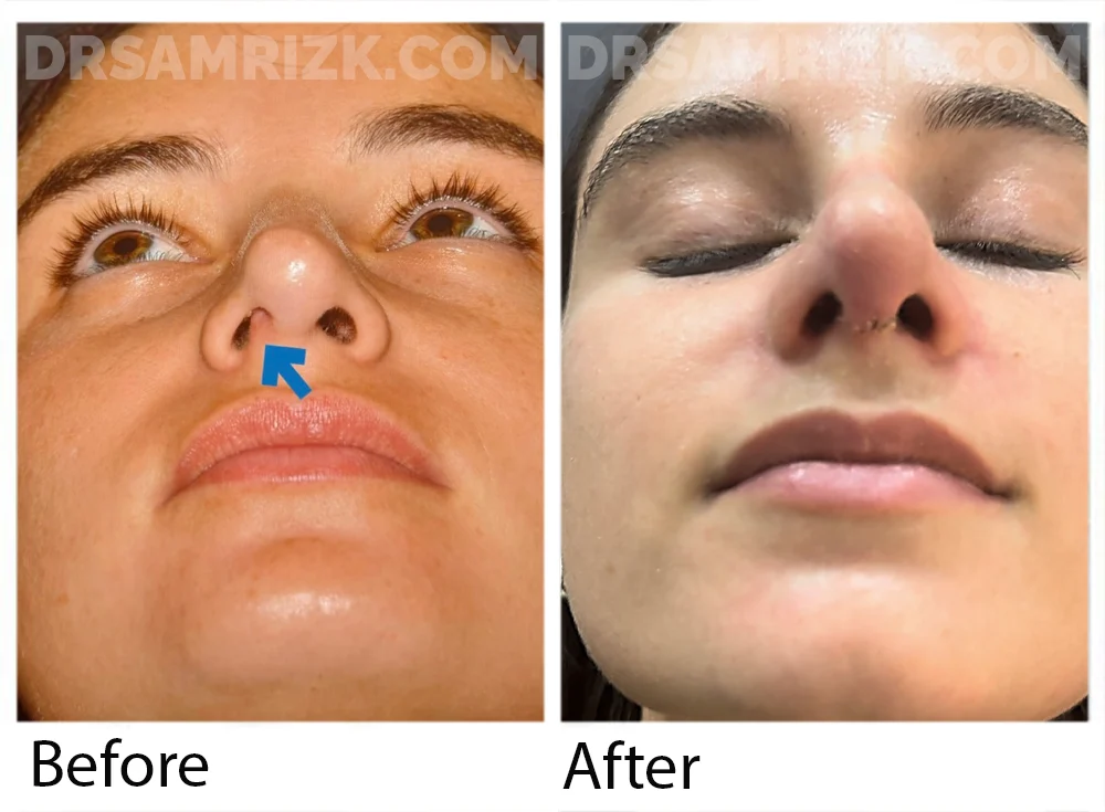 This patient is shown only I week after revision rhinoplasty / septoplasty with MTF rib bank cartilage to correct pollybeak deformity , hanging tip , collapse of right internal and external nasal valve and caudal septal deviation to the right . Her breathing and cosmetic appearance are improved post-surgery.