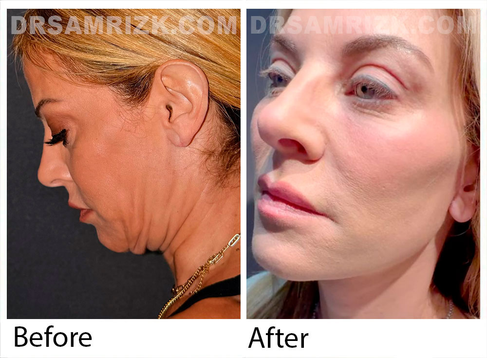 55 yo patient who underwent rapid recovery deep plane facelift / neck lift without a drain , upper blepharoplasty , lower eyelid /cheek fat transfer & full face laser. Patient is shown 2 weeks after surgery.