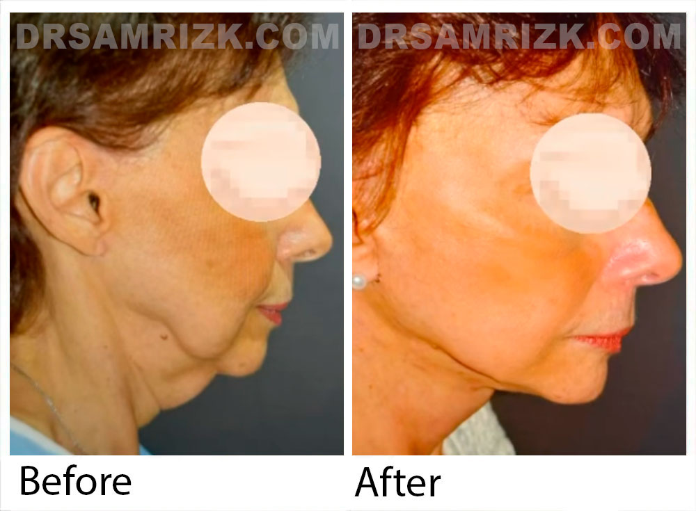 Patient is 75 yo female had a failed facelift one year prior who traveled to Dr rizk from Europe and underwent a successful revision deep plane facelift /necklift shown 3 weeks post.