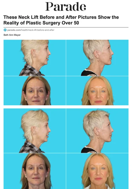 These Neck Lift Before and After Pictures Show the Reality of Plastic Surgery Over 50