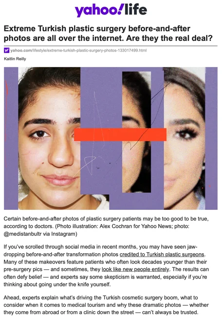 Extreme Turkish plastic surgery before-and-after photos are all over the internet. Are they the real deal?