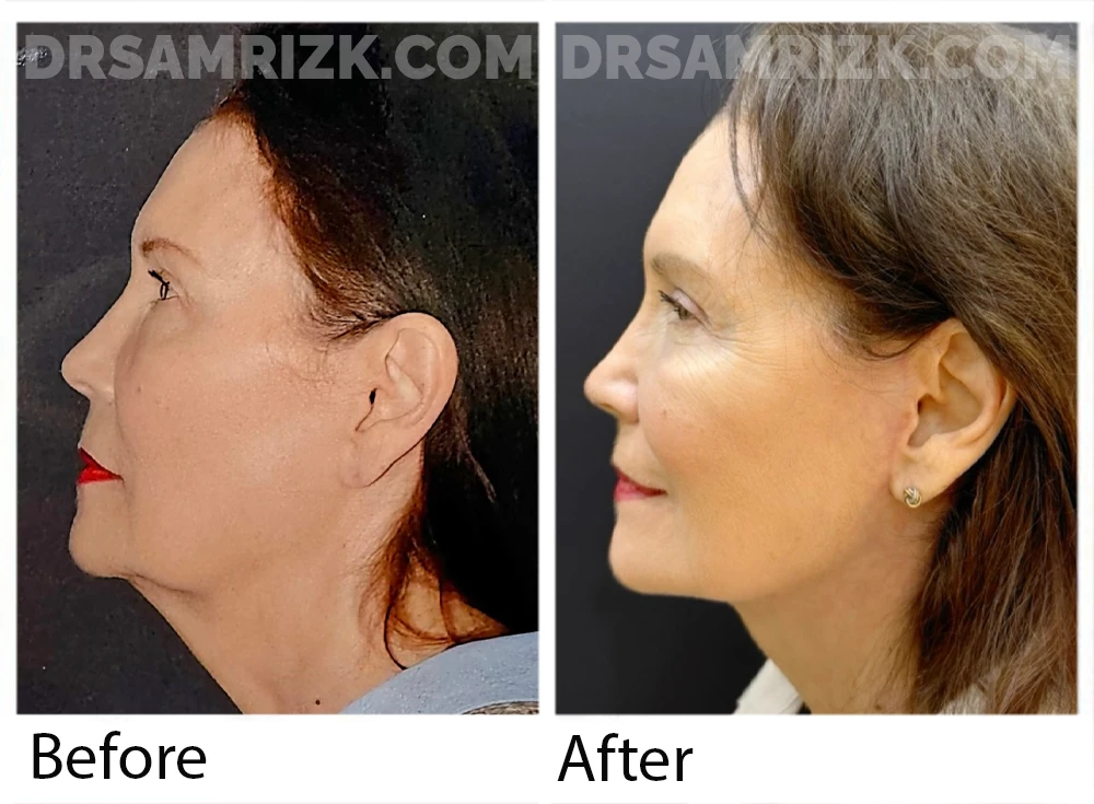 75 yo patient who is shown 1 year post deep plane facelift / deep necklift /upper blepharoplasty and temporal browlift/ laser . Note natural jawline definition with deep plane and nicely defined neck.