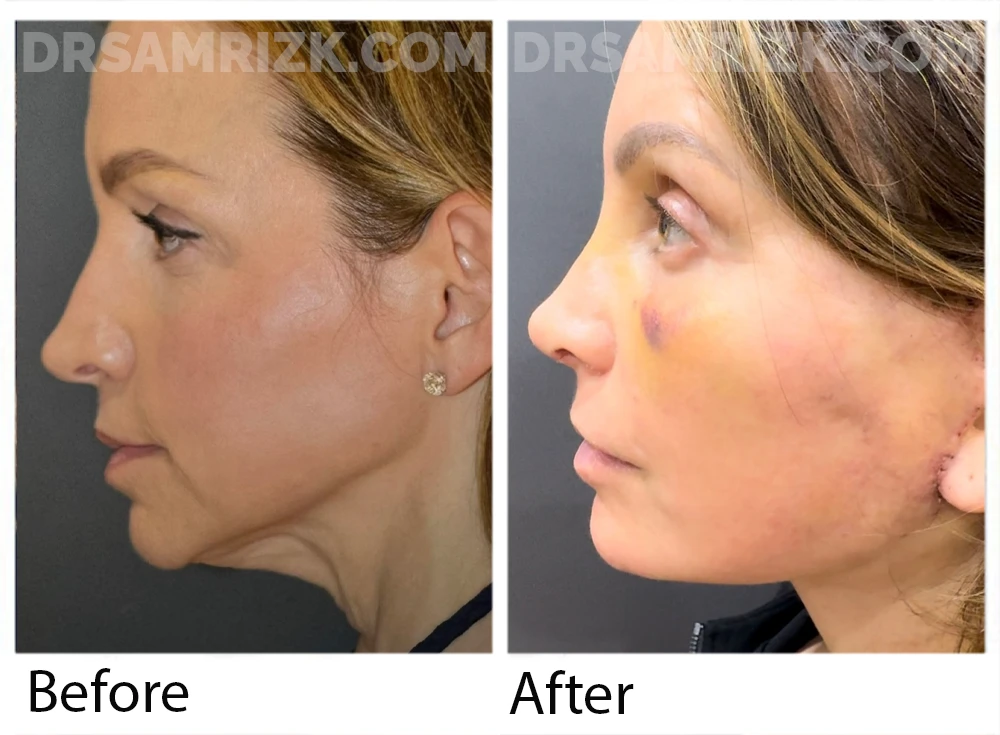 52 yo patient shown 2 weeks post deep plane facelift / deep necklift / browlift and revision rhinoplasty with rib bank cartilage and laser