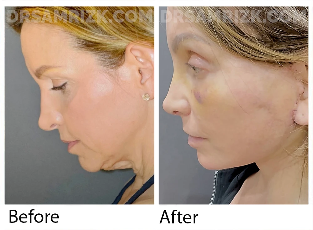 52 yo patient shown 2 weeks post deep plane facelift / deep necklift / browlift and revision rhinoplasty with rib bank cartilage and laser