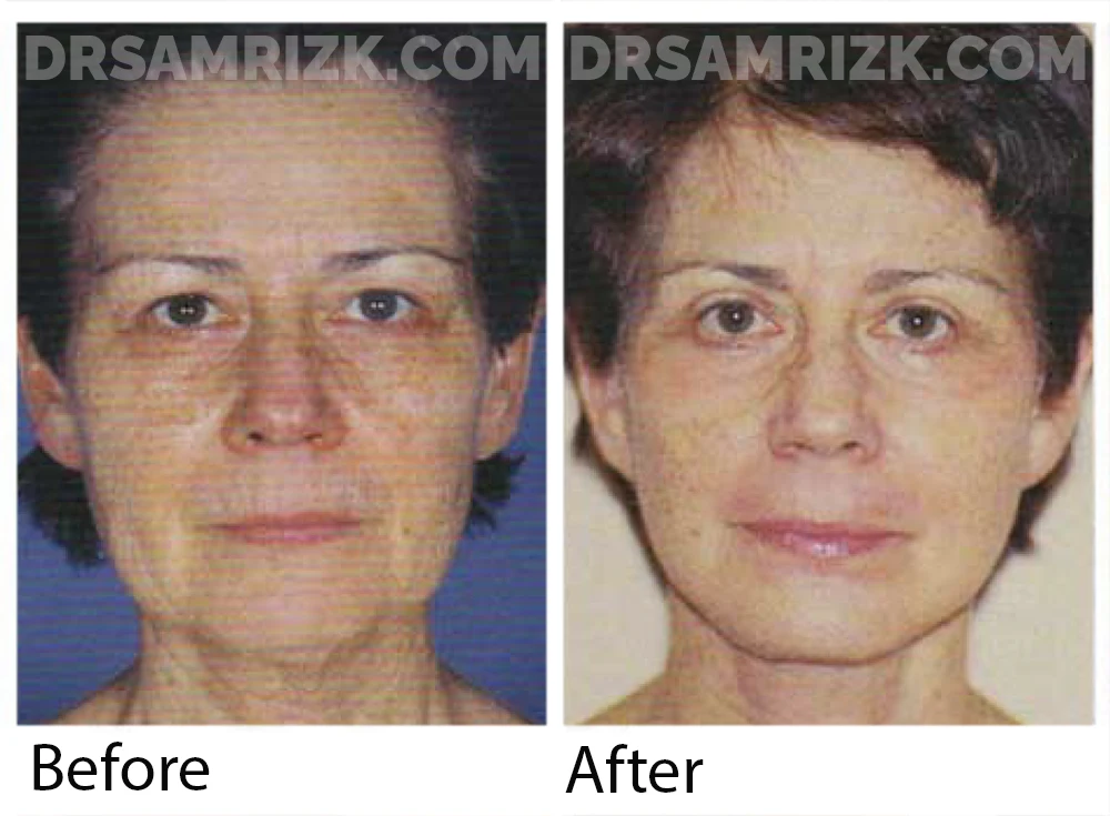 This is a 60-year-old woman who underwent short scar facelift, submentalplasty, upper and lower blepharoplasty, and periocular and perioral erbium laser skin resurfacing. Early postoperative views: Note the improvement in neck contour with the short scar facelift.