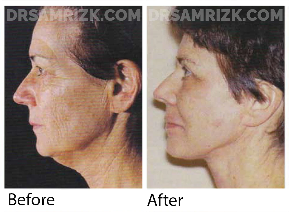 This is a 60-year-old woman who underwent short scar facelift, submentalplasty, upper and lower blepharoplasty, and periocular and perioral erbium laser skin resurfacing. Early postoperative views: Note the improvement in neck contour with the short scar facelift.