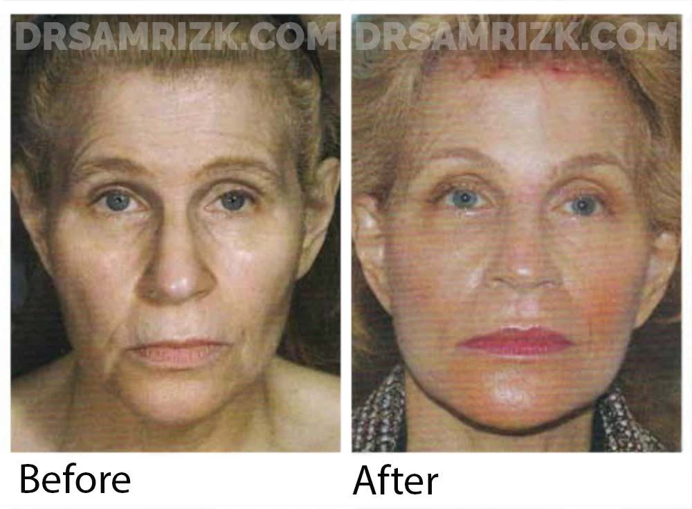 This is a 58-year-old woman who underwent a short scar facelift, submentalplasty, anterior browlift, and perioral erbium laser skin resurfacing. Postoperative views shown at 3 months.