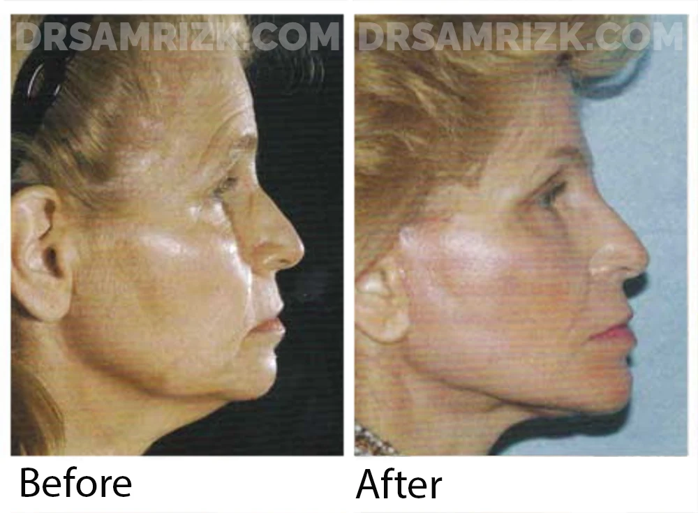 This is a 58-year-old woman who underwent a short scar facelift, submentalplasty, anterior browlift, and perioral erbium laser skin resurfacing. Postoperative views shown at 3 months.