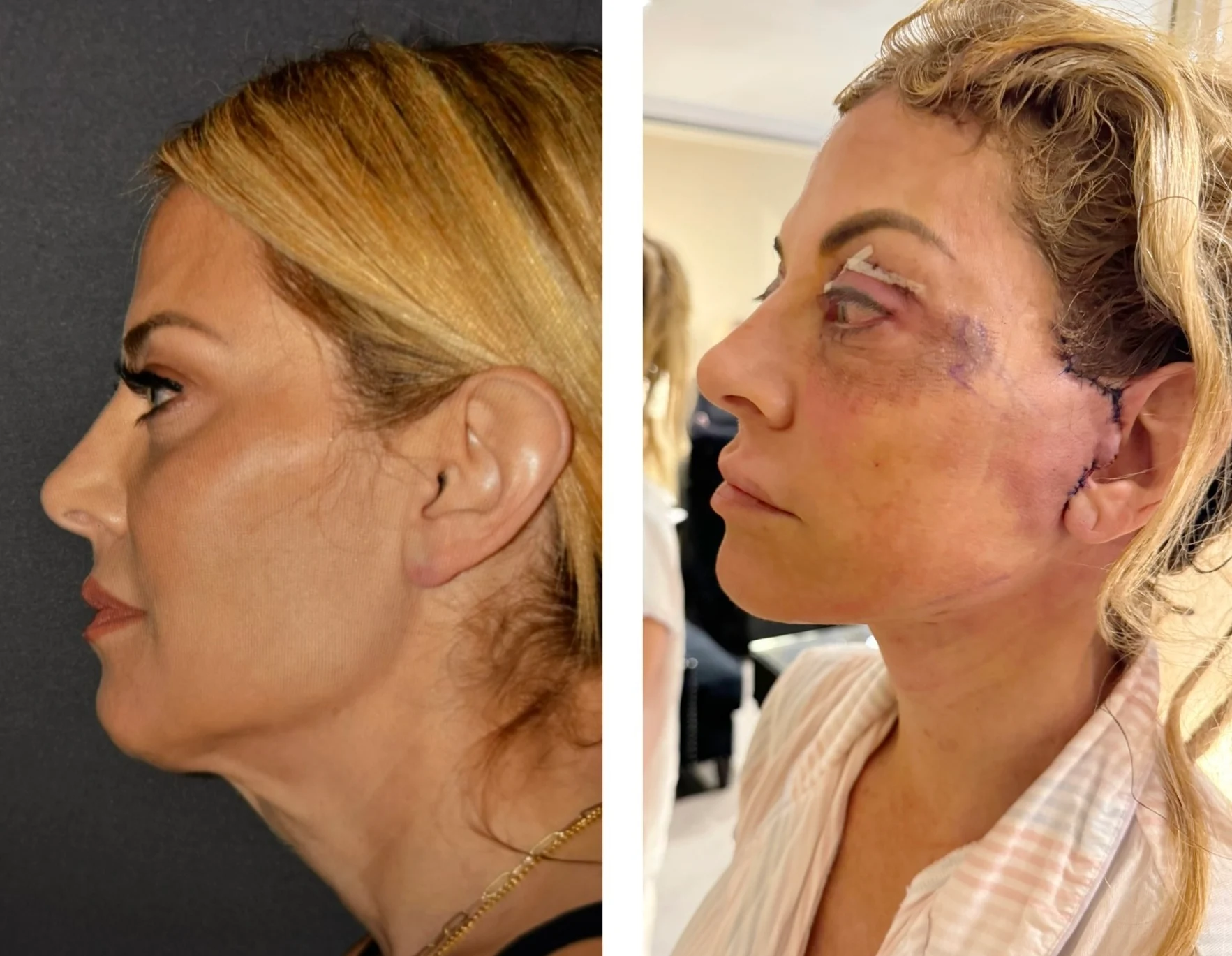 Dr Rizk Facelift Patient Recovery With ARTISS Tissue Sealant