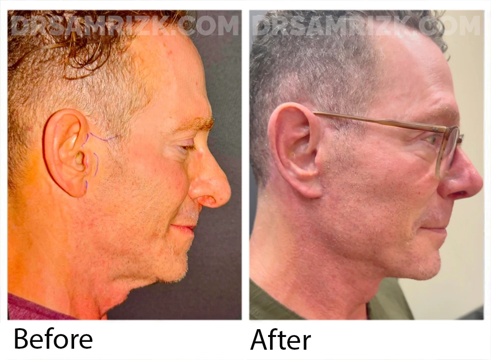 Patient is show 4 months post deep plane facelift/necklift / rhinoplasty / otoplasty. He traveled from Beverly Hills to New York seeking understated elegance and a natural look . His scars are already imperceptible