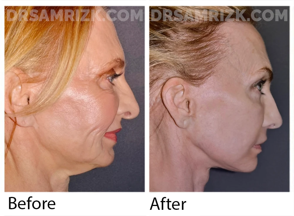 Pt is a heart doctor underwent revision facelift , lip lift , revision rhinoplasty with rib bank cartilage , temporal browlift , blepharoplasty / laser and removal of bellafil filler . Patient is shown 1 year post when she came back to do fat grafting which is why the postoperative picture is shown without makeup and in a surgical gown.