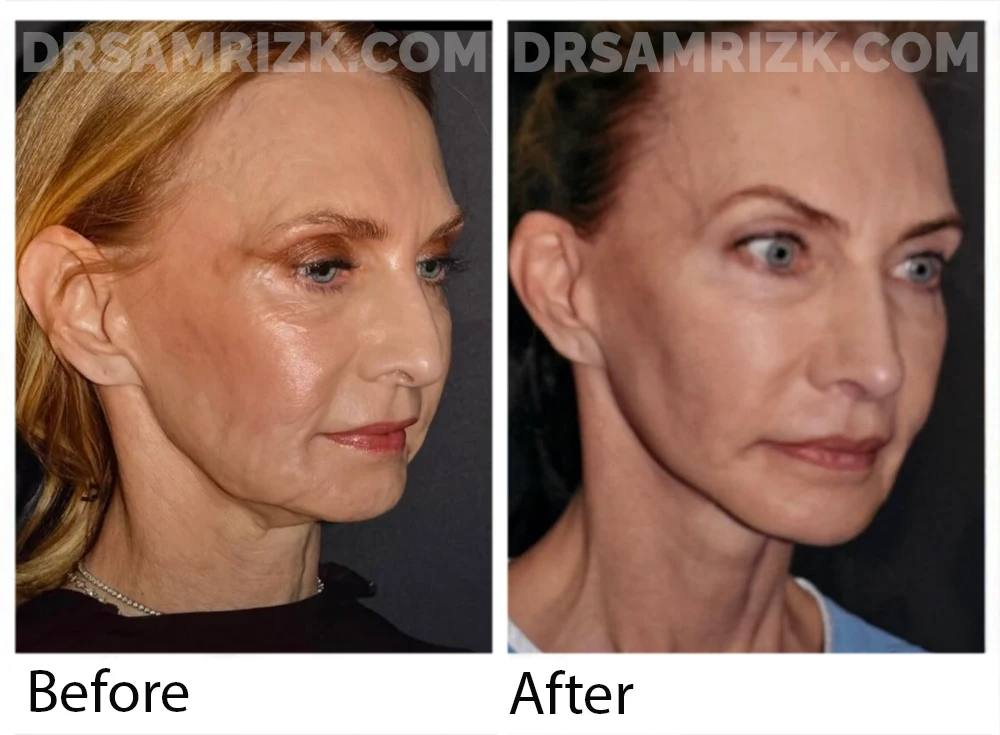 Pt is a heart doctor underwent revision facelift , lip lift , revision rhinoplasty with rib bank cartilage , temporal browlift , blepharoplasty / laser and removal of bellafil filler . Patient is shown 1 year post when she came back to do fat grafting which is why the postoperative picture is shown without makeup and in a surgical gown.