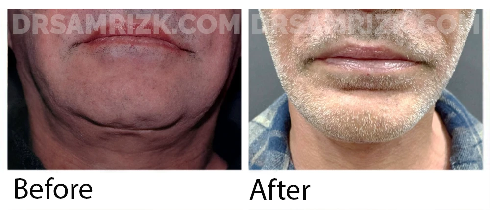 Patient is a bald man shown only 3 days post revision deep plane facelift /necklift and chin implant . Note jawline definition and minimal bruising with Dr Rizk ‘s rapid recovery tissue sealant drainless deep plane facelift