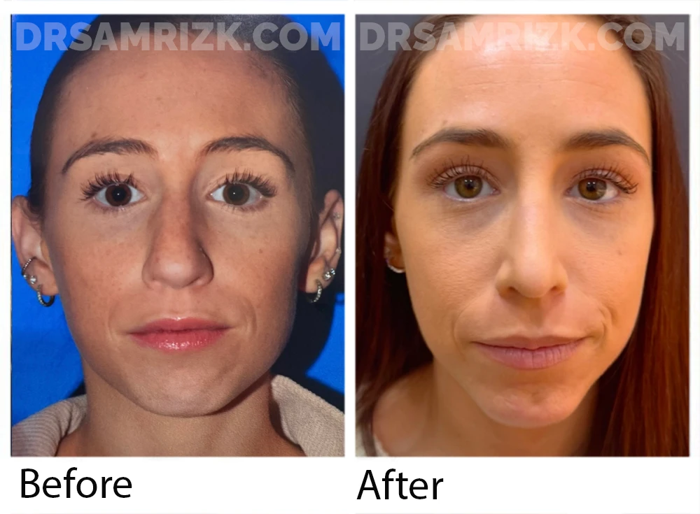 Patient is shown 1 year after rhinoplasty /chin implant.