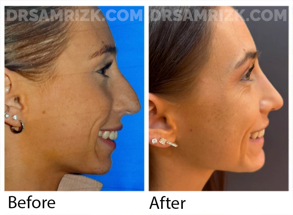 Patient is shown 1 year after rhinoplasty /chin implant